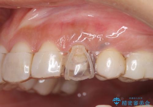 犬歯の変色　マウスピースで手軽にエクストリュージョン　歯ぐきの炎症をおさめますの治療中
