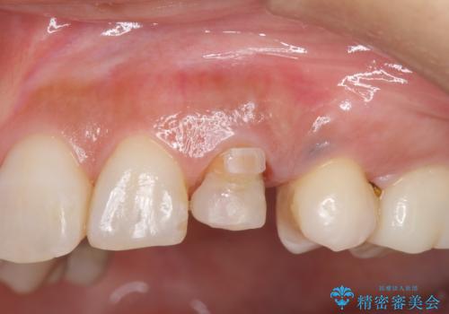 犬歯の変色 マウスピースで手軽にエクストリュージョン 歯ぐきの炎症をおさめますの治療中