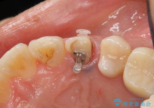 犬歯の変色 マウスピースで手軽にエクストリュージョン 歯ぐきの炎症をおさめますの治療中