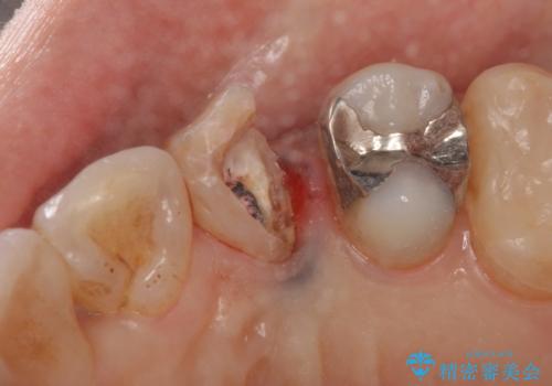 犬歯の変色　マウスピースで手軽にエクストリュージョン　歯ぐきの炎症をおさめますの治療前