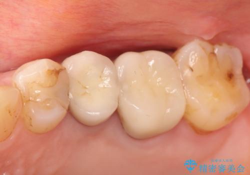 奥歯が痛い。根管治療~オールセラミッククラウンの治療の治療後