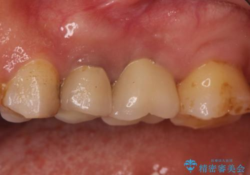 奥歯が痛い。根管治療~オールセラミッククラウンの治療の治療後