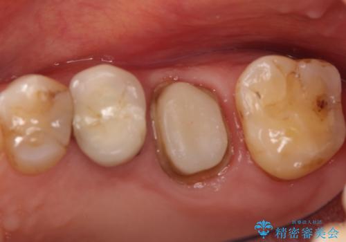 奥歯が痛い。根管治療~オールセラミッククラウンの治療の治療中