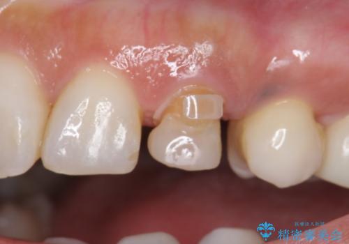 犬歯の変色 マウスピースで手軽にエクストリュージョン 歯ぐきの炎症をおさめますの治療中