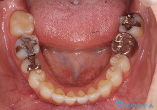 セラミックインレー 下の一番奥歯 歯ぐきの厚みを減らしてぴったりに入れます(ディスタルウェッジ+骨外科)の治療前