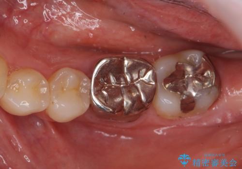 セラミックインレー　下の一番奥歯　歯ぐきの厚みを減らしてぴったりに入れます(ディスタルウェッジ+骨外科)の症例 治療前