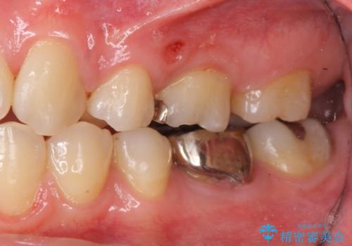 セラミックインレー　下の一番奥歯　歯ぐきの厚みを減らしてぴったりに入れます(ディスタルウェッジ+骨外科)の治療前