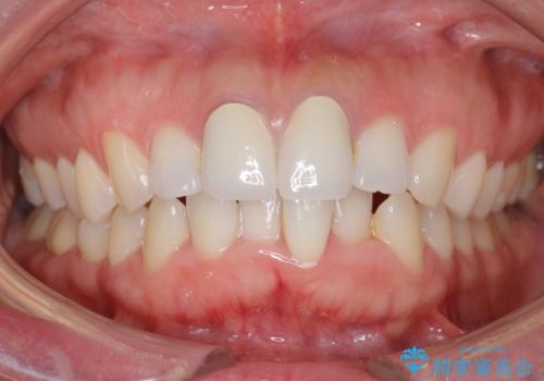 口ゴボでお悩みの方必見! 不自然なセラミックをやり直す矯正 セラミックだけでは、口元は下がりません。の治療前