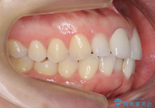口ゴボでお悩みの方必見! 不自然なセラミックをやり直す矯正 セラミックだけでは、口元は下がりません。