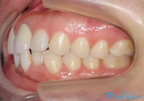 口ゴボでお悩みの方必見! 不自然なセラミックをやり直す矯正 セラミックだけでは、口元は下がりません。の治療前