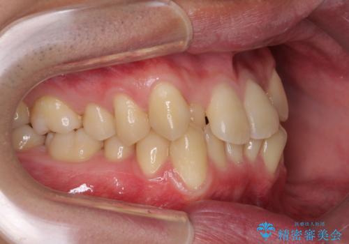 前歯のガタガタの矯正　下顎の前歯を1本抜歯してのインビザライン矯正の治療前