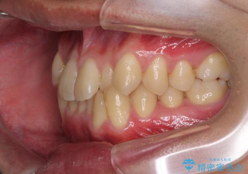 前歯のガタガタの矯正 下顎の前歯を1本抜歯してのインビザライン矯正の治療前