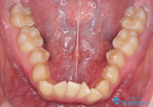 前歯のガタガタの矯正　下顎の前歯を1本抜歯してのインビザライン矯正の治療前
