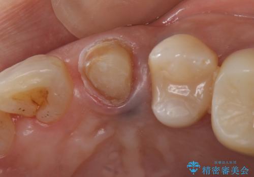 犬歯の変色 マウスピースで手軽にエクストリュージョン 歯ぐきの炎症をおさめますの治療中