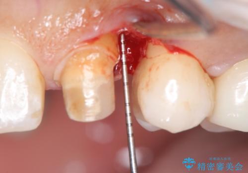 犬歯の変色 マウスピースで手軽にエクストリュージョン 歯ぐきの炎症をおさめますの治療中