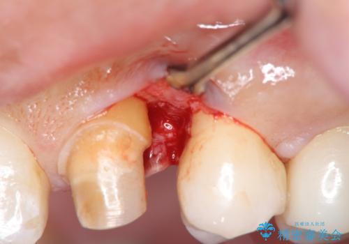 犬歯の変色 マウスピースで手軽にエクストリュージョン 歯ぐきの炎症をおさめますの治療中