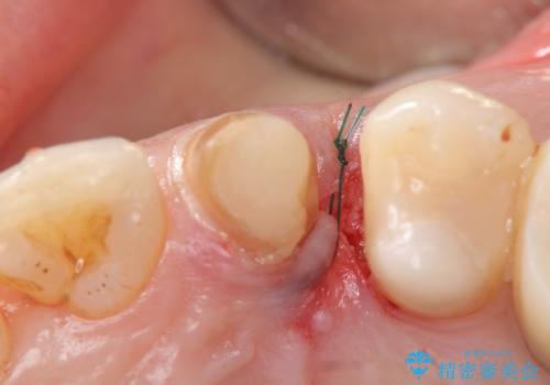 犬歯の変色　マウスピースで手軽にエクストリュージョン　歯ぐきの炎症をおさめますの治療中