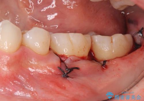 他院で次に虫歯になったら治せないと言われた 歯周外科手術でしっかり治療(APF)の治療中