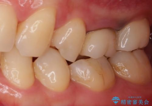 痛みの続いた歯を原因から治療の治療後