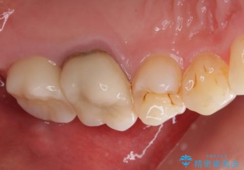 痛みの続いた歯を原因から治療の治療後