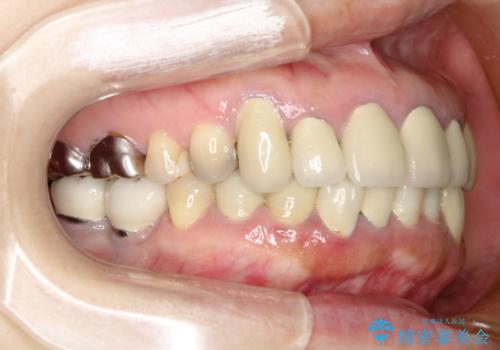 この際全てをしっかりと治療したい 総合歯科治療の治療前