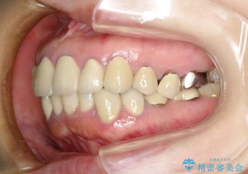 この際全てをしっかりと治療したい 総合歯科治療の治療前