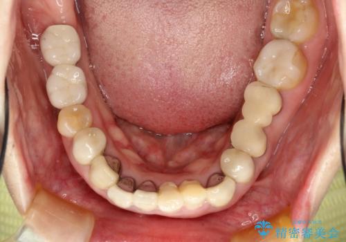 この際全てをしっかりと治療したい 総合歯科治療の治療前