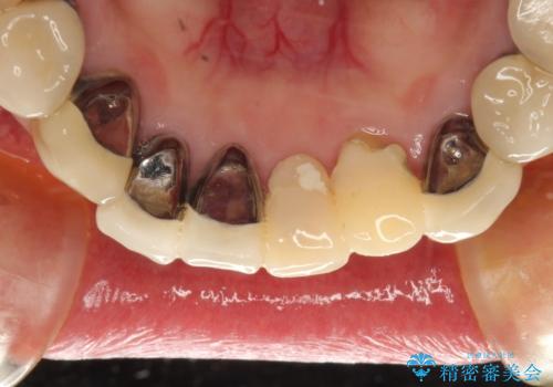 この際全てをしっかりと治療したい 総合歯科治療の治療前
