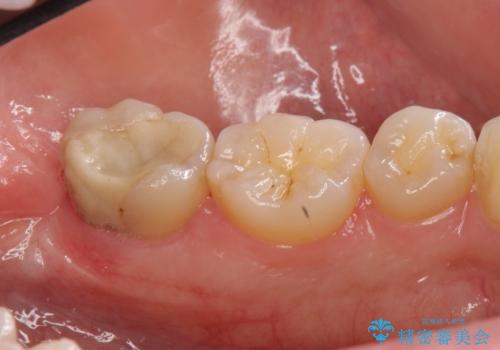 他院で次に虫歯になったら治せないと言われた 歯周外科手術でしっかり治療(APF)の治療中