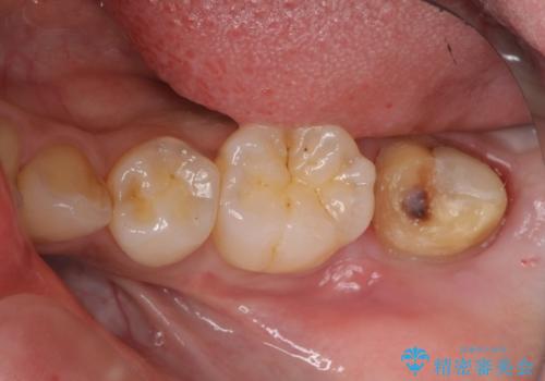他院で次に虫歯になったら治せないと言われた　歯周外科手術でしっかり治療(APF)の治療中