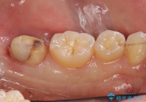 他院で次に虫歯になったら治せないと言われた　歯周外科手術でしっかり治療(APF)の治療中
