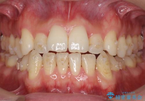 受け口 マウスピースで矯正治療 難易度:中の治療中