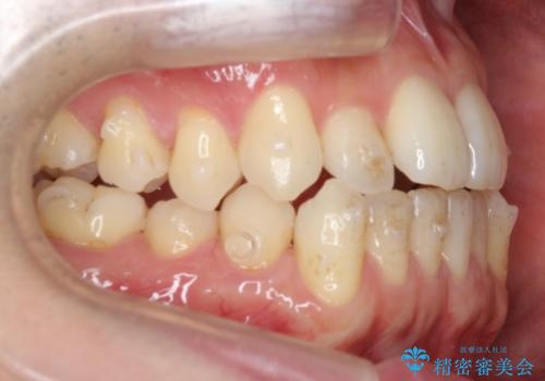 受け口 マウスピースで矯正治療 難易度:中の治療中