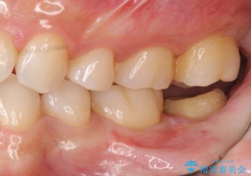 他院で次に虫歯になったら治せないと言われた 歯周外科手術でしっかり治療(APF)の治療中