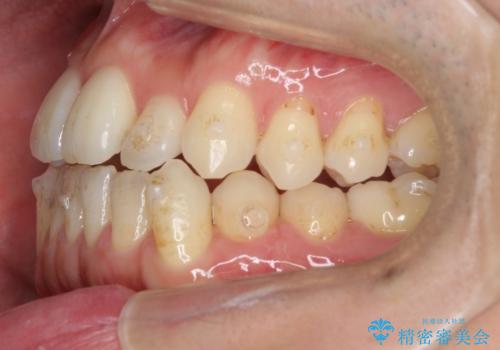 受け口 マウスピースで矯正治療 難易度:中の治療中