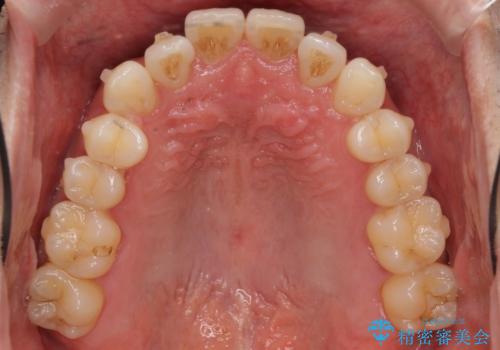 受け口 マウスピースで矯正治療 難易度:中の治療中