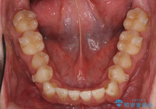 受け口 マウスピースで矯正治療 難易度:中の治療中