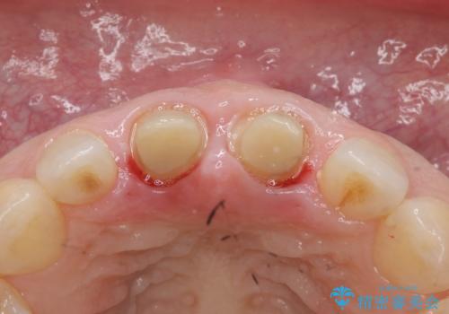 口ゴボでお悩みの方必見! 不自然なセラミックをやり直す矯正 セラミックだけでは、口元は下がりません。の治療中