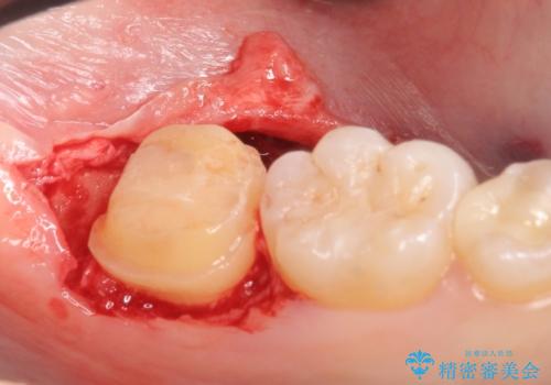 オールセラミッククラウン 奥歯の虫歯・深いポケットの除去の治療中