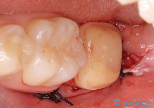 オールセラミッククラウン　奥歯の虫歯・深いポケットの除去の治療後