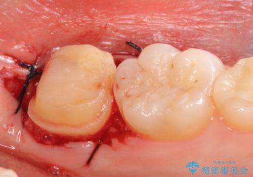 オールセラミッククラウン 奥歯の虫歯・深いポケットの除去の治療後