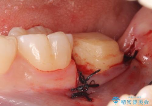 オールセラミッククラウン 奥歯の虫歯・深いポケットの除去の治療後