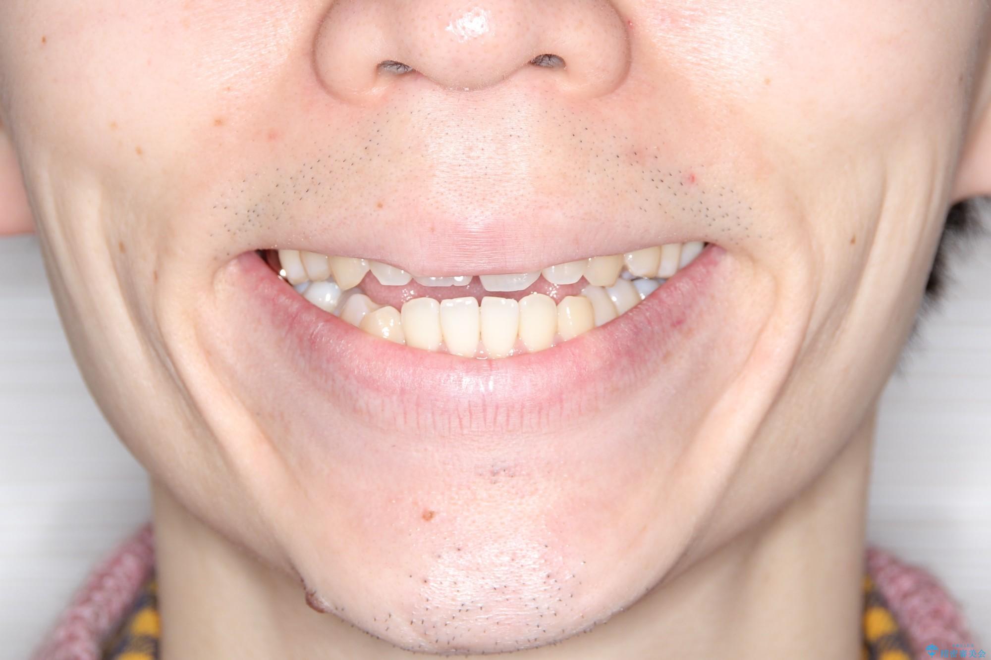 前歯でものが噛み切れない　インビザラインによるオープンバイトの治療の治療前（顔貌）