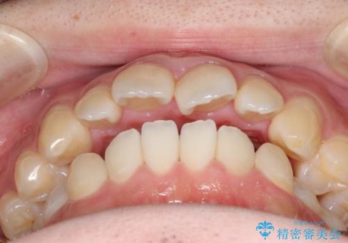 前歯でものが噛み切れない インビザラインによるオープンバイトの治療の治療前
