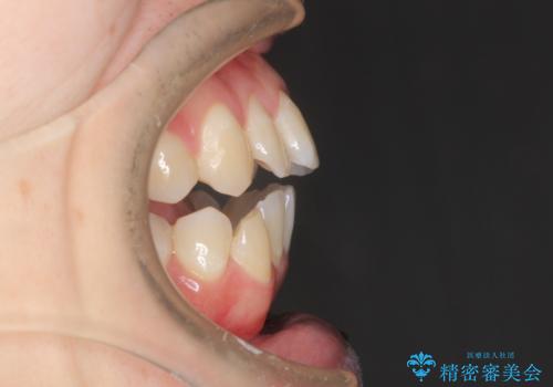 前歯でものが噛み切れない インビザラインによるオープンバイトの治療の治療前