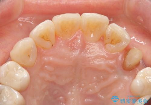 犬歯の変色 マウスピースで手軽にエクストリュージョン 歯ぐきの炎症をおさめますの治療中