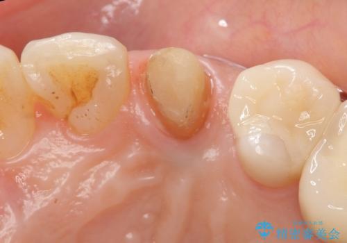 犬歯の変色 マウスピースで手軽にエクストリュージョン 歯ぐきの炎症をおさめますの治療後