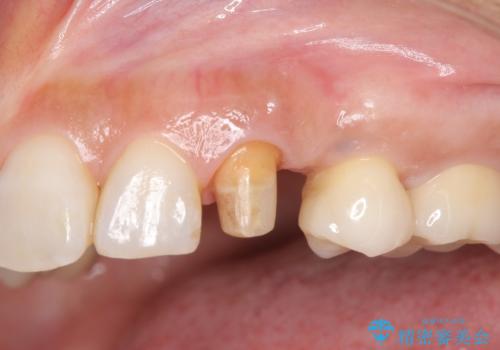 犬歯の変色 マウスピースで手軽にエクストリュージョン 歯ぐきの炎症をおさめますの治療中