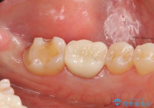 セラミックインレー　下の一番奥歯　歯ぐきの厚みを減らしてぴったりに入れます(ディスタルウェッジ+骨外科)