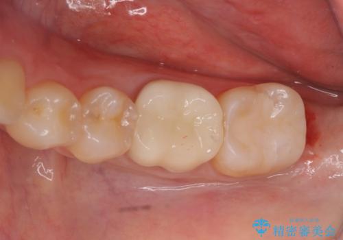 セラミックインレー　下の一番奥歯　歯ぐきの厚みを減らしてぴったりに入れます(ディスタルウェッジ+骨外科)の症例 治療後